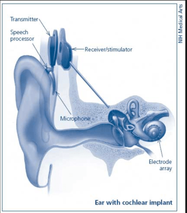 To visually understand how a cochlear implant works, this photo depicts the internal and external portions working together to create hearing for a CI user.